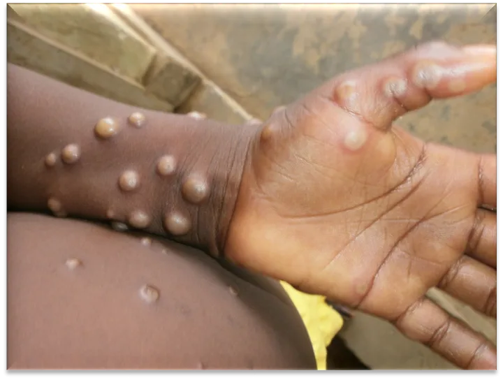 What you need to know about monkeypox