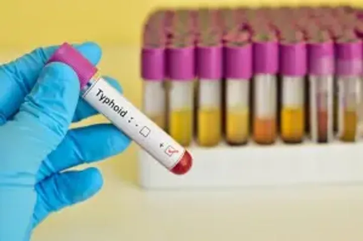 A Breakthrough in Rapid Diagnosis of Typhoid
