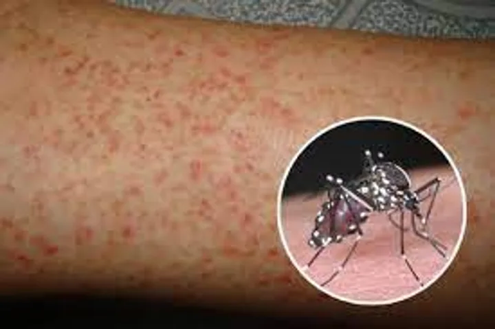 Dengue fever virus increases, learn more