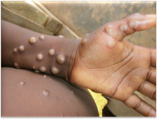 What you need to know about monkeypox